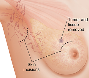 Three-quarter view of female underarm area showing breast anatomy ghosted in. Incisions in underarm and on breast for lumpectomy.