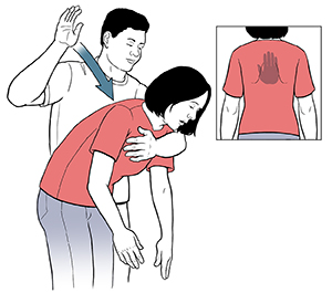 Man standing behind woman with one arm supporting her upper chest and another arm raised over her back. Arrow indicates arm coming down onto her back as she bends over. Inset shows hand position on back between the shoulder blades.